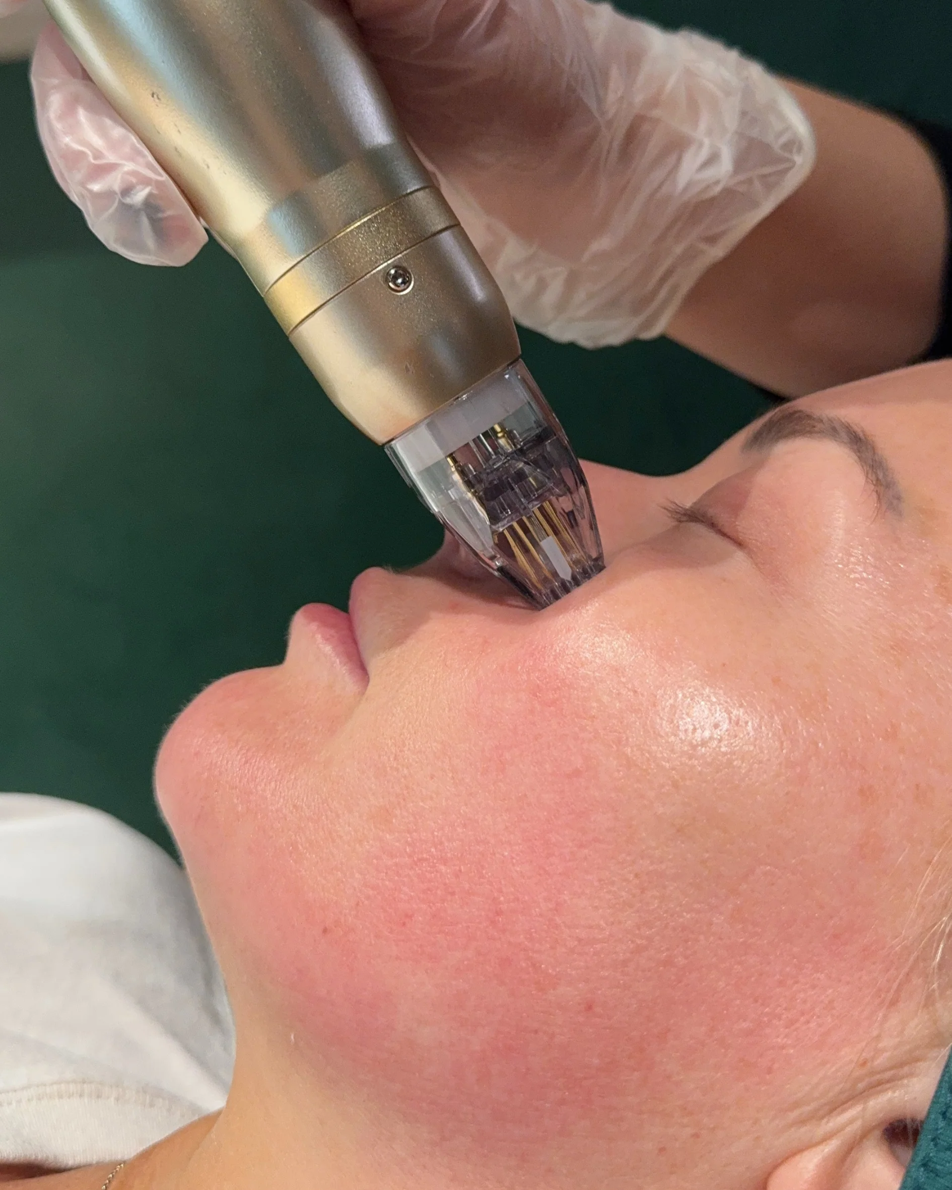 First-Time RF Needling with Consultation & LED - Online Exclusive - Image 4