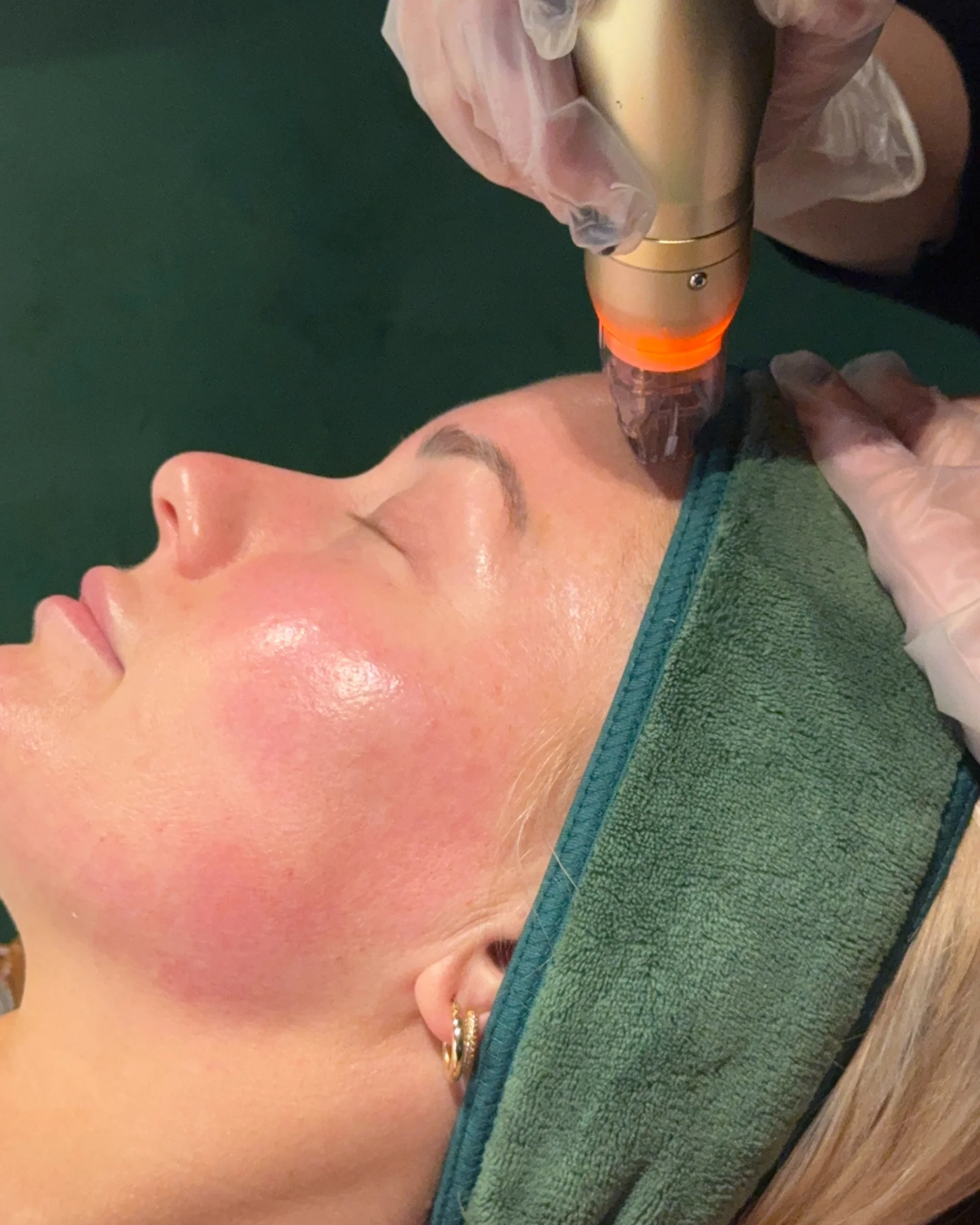 First-Time RF Needling with Consultation & LED - Online Exclusive - Image 5