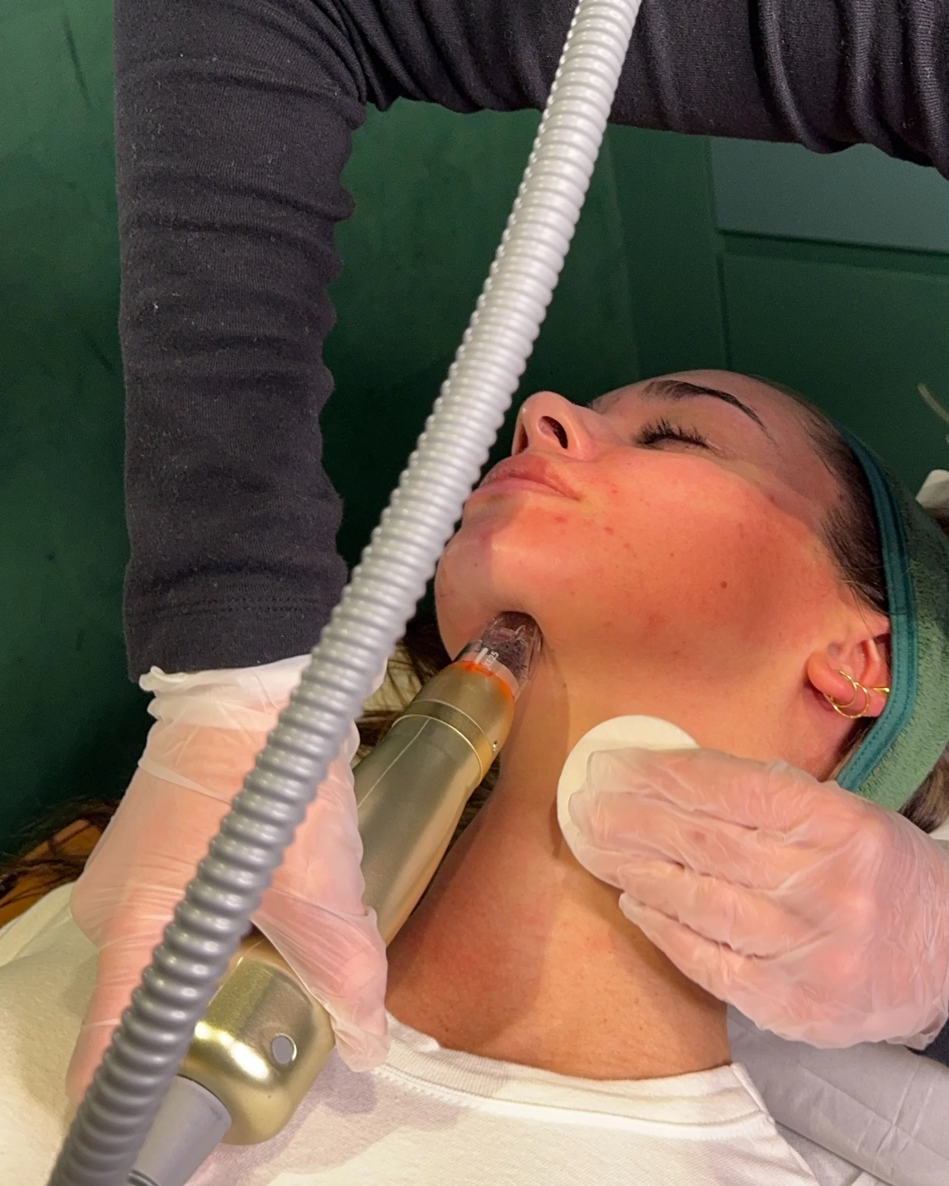 First-Time RF Needling with Consultation & LED - Online Exclusive - Image 6