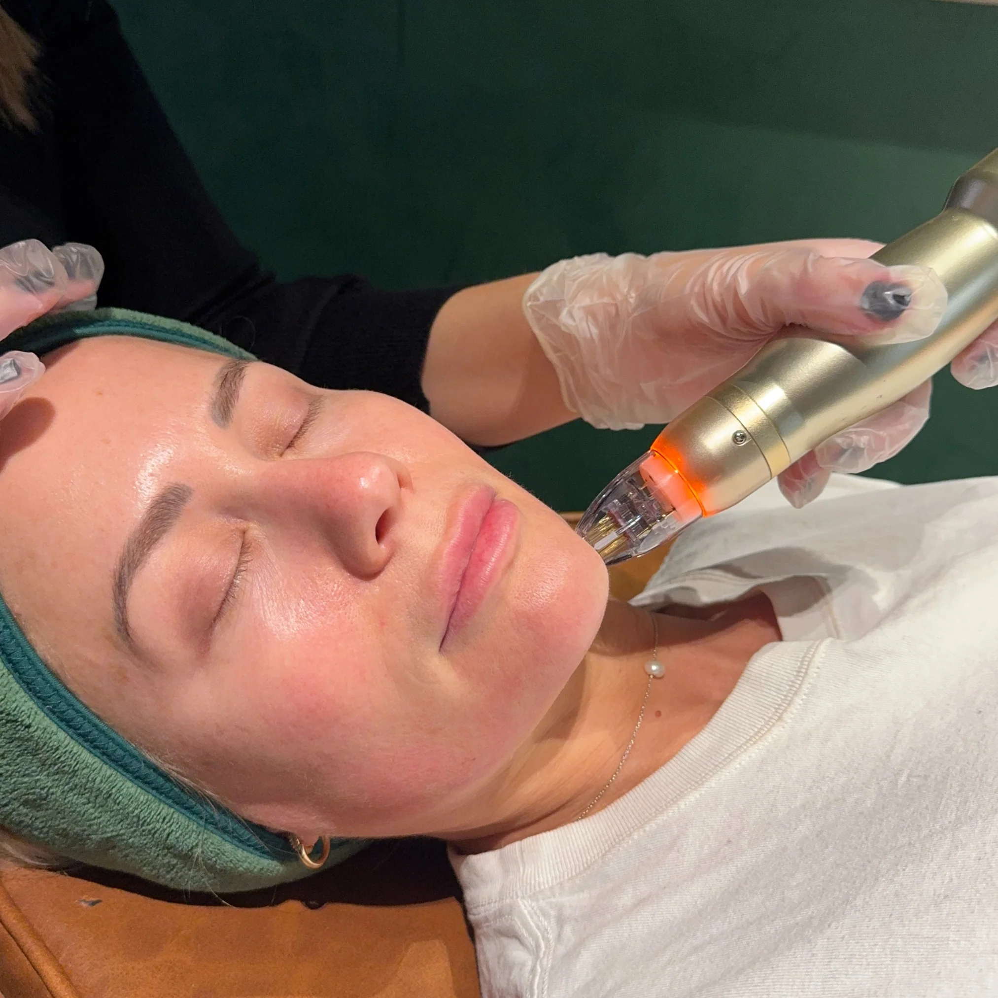 RF Needling x 3 Series - Image 3