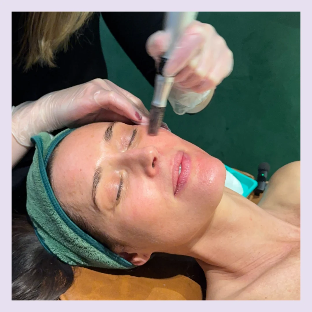 First-Time Skin Needling with Consultation & LED - Image 5