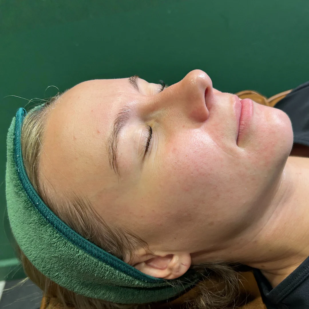 RF Needling - Image 3