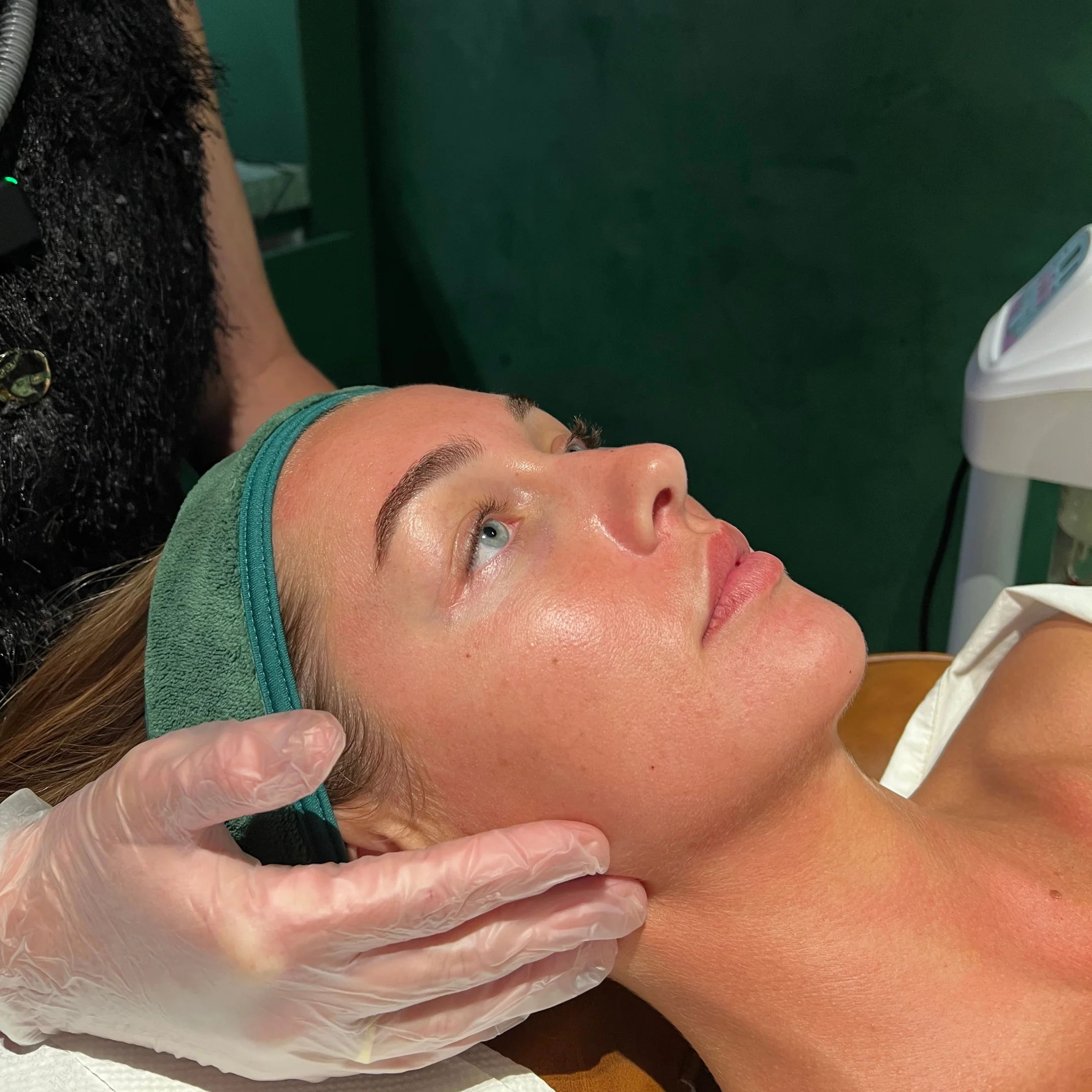Skin Needling - Image 3