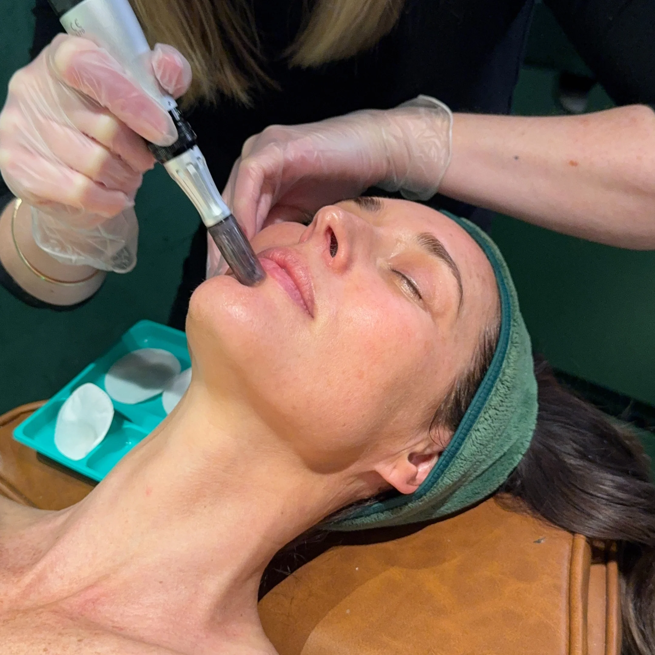 Skin Needling x 3 Series - Image 4